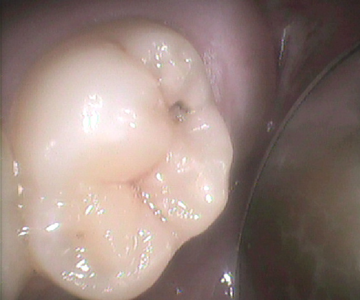 虫歯の穴が確認できる