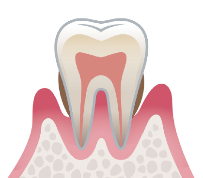 歯茎がブヨブヨとし、歯槽骨も溶けていく